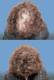 Camouflage des cheveux par les fibres Nanogen chez la femme